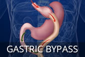 Darebin-weight-loss-surgery-gastrIc-bypass