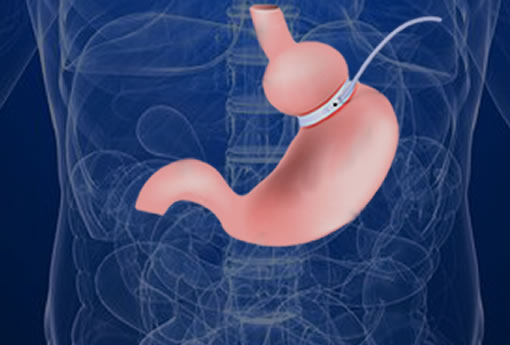 Darebin-weight-loss-surgery-gastric-band